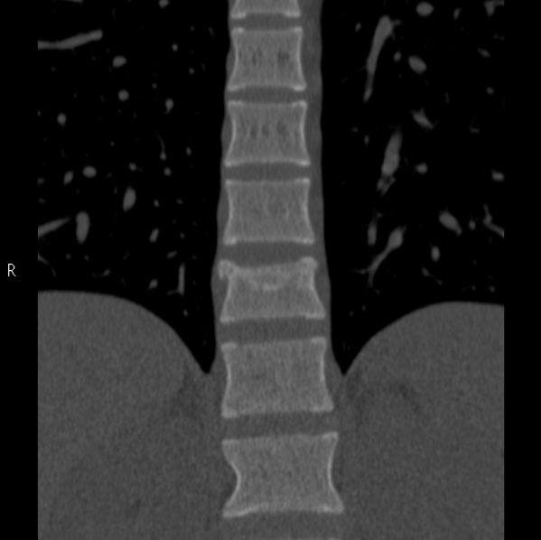 Chance fracture (Radiopaedia 36521-38081 Coronal bone window 14).jpg
