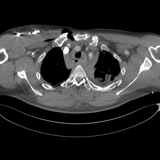 File:Chest multitrauma - aortic injury (Radiopaedia 34708-36147 A 61).png