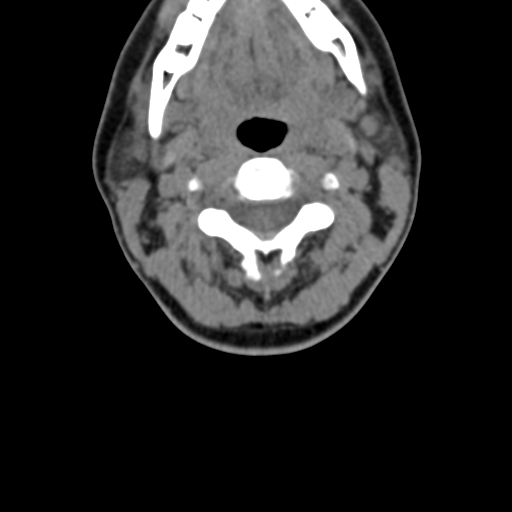 Chiari I malformation and obstructive hydrocephalus (Radiopaedia 41185-43981 D 43).png