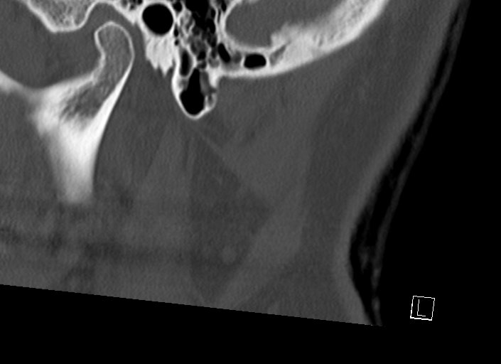 Chiari I malformation with a symptomatic syrinx of the posterolateral medulla oblongata (Radiopaedia 42573-45707 A 57).jpg