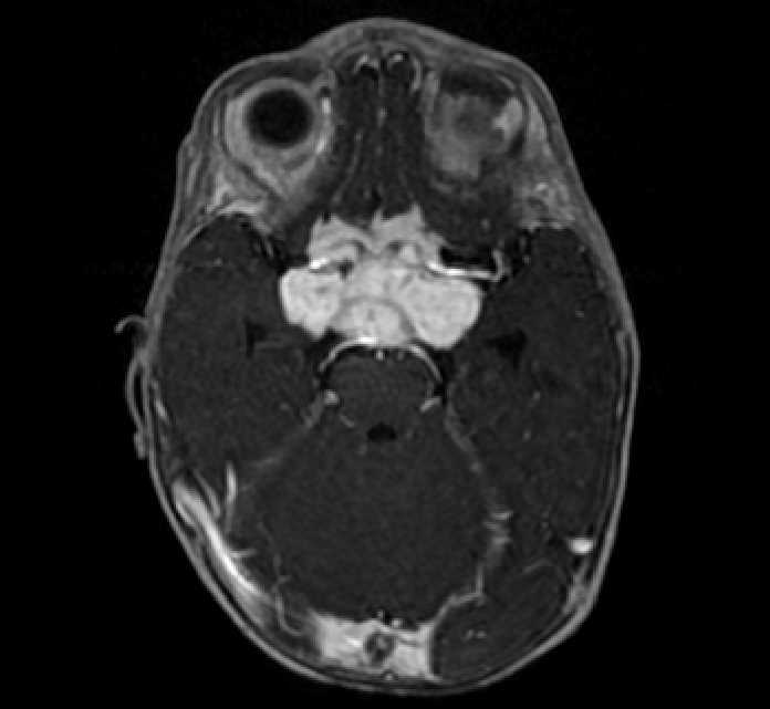 Chiasmatic-hypothalamic glioma (Radiopaedia 90079-107252 Axial T1 C+ 28).jpg