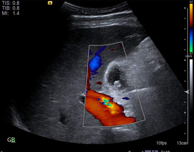 File:Cholecystitis - perforated gallbladder (Radiopaedia 57038-63913 A 16).jpg