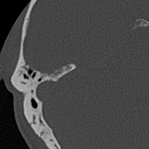 File:Cholesteatoma (Radiopaedia 15846-15494 bone window 1).jpg