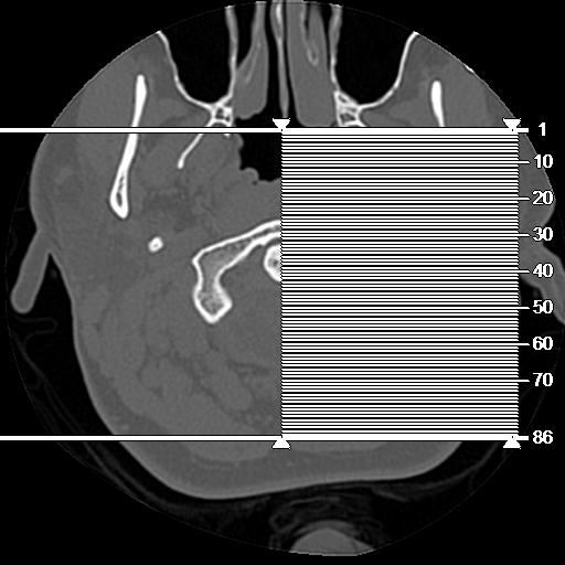 Cholesteatoma (Radiopaedia 84960-100474 Coronal bone window 1).jpg