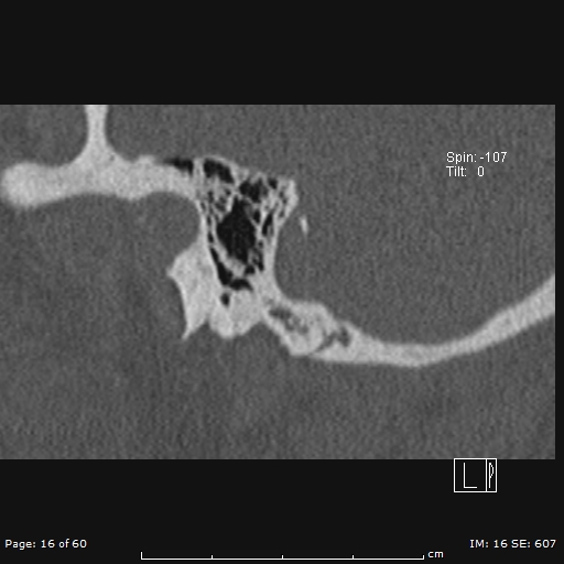 File:Cholesteatoma - external auditory canal (Radiopaedia 88452-105096 Sagittal bone window 16).jpg