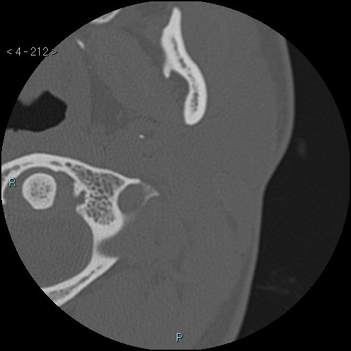 Cholesterol granuloma of the petrous apex (Radiopaedia 64358-73141 Axial bone window 102).jpg