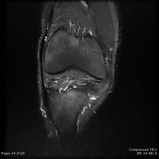 File:Chondroblastoma (Radiopaedia 25725-25891 Coronal STIR 14).jpg