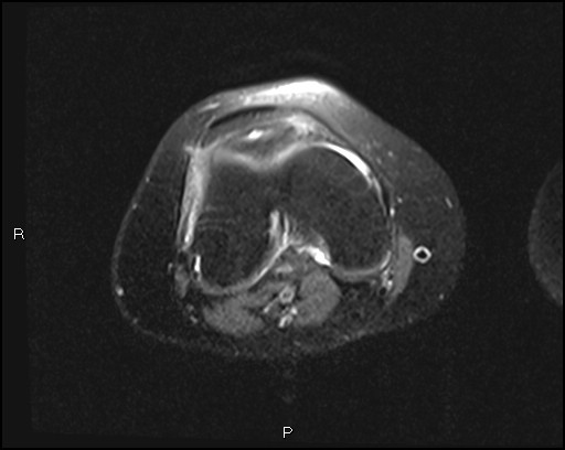 File:Chondroblastoma (Radiopaedia 62721-71031 Axial PD fat sat 17).jpg