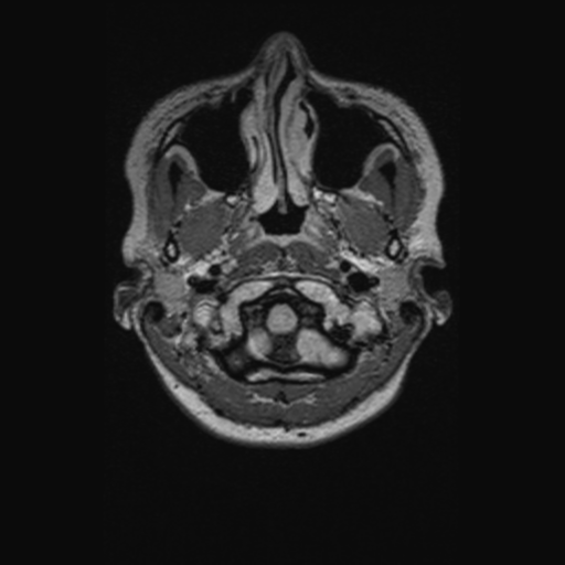 Chondrosarcoma (Radiopaedia 41937-44939 Axial FLAIR 12).png