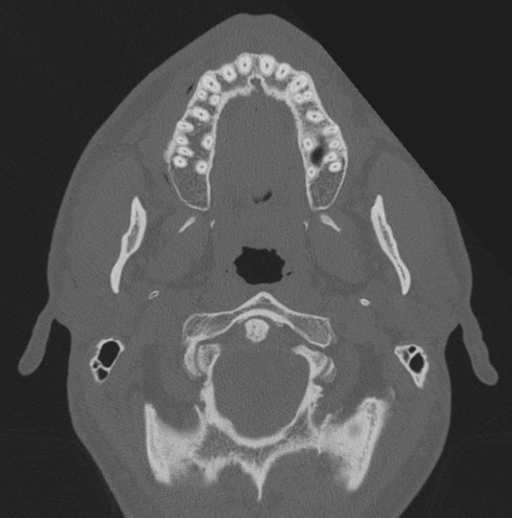 Chondrosarcoma (clivus) (Radiopaedia 46895-51425 Axial bone window 80).png