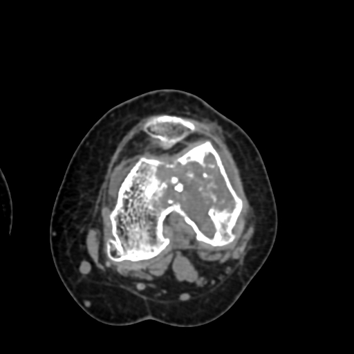 Chondrosarcoma - femur (Radiopaedia 64187-72954 Axial non-contrast 47).jpg