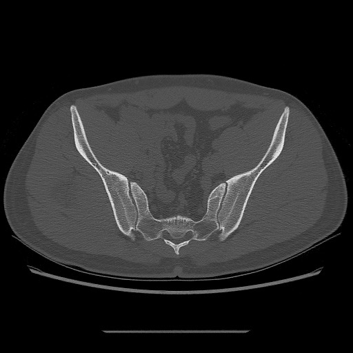 File:Chondrosarcoma of iliac wing (Radiopaedia 63861-72599 Axial bone window 68).jpg