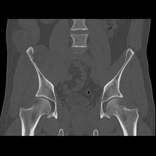 File:Chondrosarcoma of iliac wing (Radiopaedia 63861-72599 Coronal bone window 59).jpg