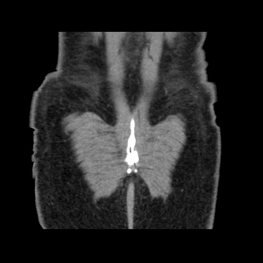 Chondrosarcoma of iliac wing (Radiopaedia 63861-72599 Coronal non-contrast 106).jpg