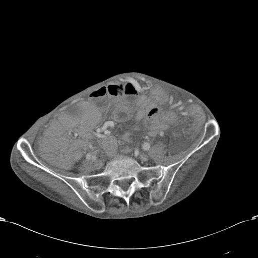 File:Chondrosarcoma of the spine (Radiopaedia 49871-55143 A 44).jpg