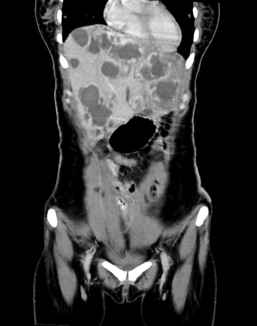 Choriocarcinoma liver metastases (Radiopaedia 74768-85766 B 30).jpg