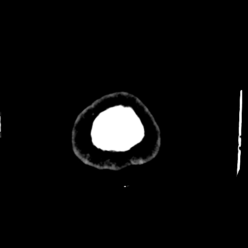 File:Choroid plexus xanthogranulomas (Radiopaedia 51621-57408 Axial non-contrast 119).jpg