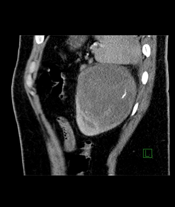 Chromophobe renal cell carcinoma (Radiopaedia 84255-99542 E 12).jpg