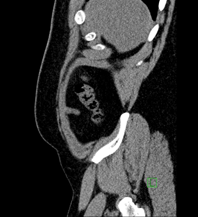 Chromophobe renal cell carcinoma (Radiopaedia 84286-99573 C 171).jpg