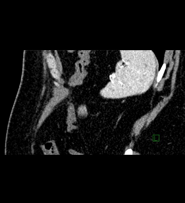 Chromophobe renal cell carcinoma (Radiopaedia 84286-99573 F 21).jpg
