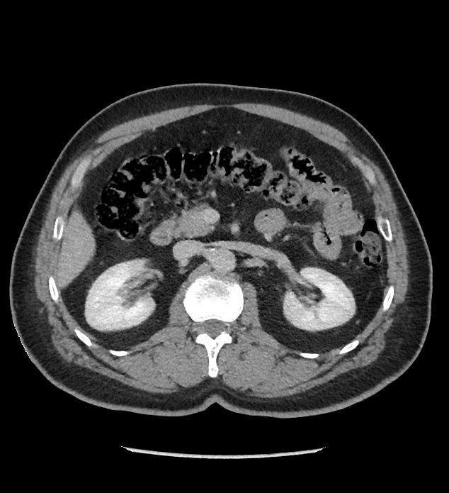 Chromophobe renal cell carcinoma (Radiopaedia 86879-103083 C 56).jpg