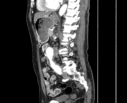 Chronic contained rupture of abdominal aortic aneurysm with extensive erosion of the vertebral bodies (Radiopaedia 55450-61901 B 43).jpg