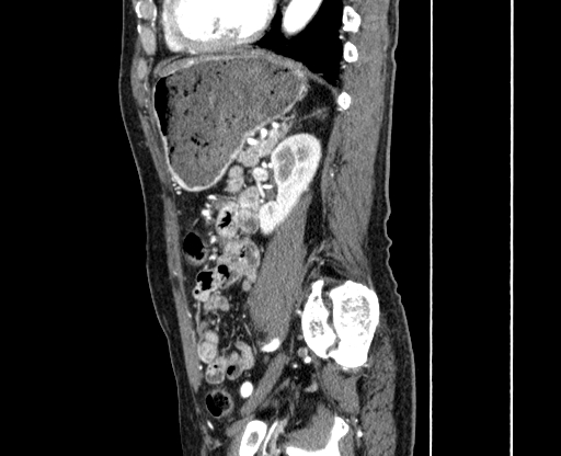File:Chronic contained rupture of abdominal aortic aneurysm with extensive erosion of the vertebral bodies (Radiopaedia 55450-61901 B 54).jpg