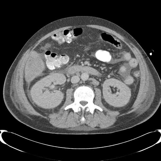 Chronic diverticulitis complicated by hepatic abscess and portal vein thrombosis (Radiopaedia 30301-30938 A 47).jpg