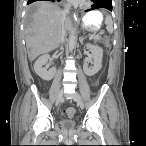 Chronic diverticulitis complicated by hepatic abscess and portal vein thrombosis (Radiopaedia 30301-30938 B 35).jpg