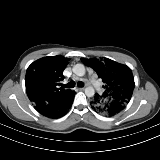 Chronic eosinophilic pneumonia (Radiopaedia 39331-41587 Axial C+ delayed 45).png
