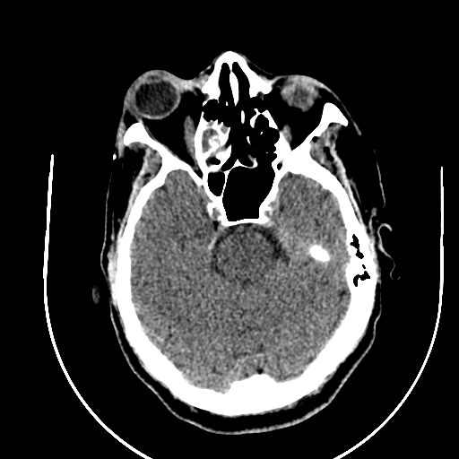 File:Chronic invasive fungal sinusitis (Radiopaedia 91563-109286 Axial non-contrast 31).jpg
