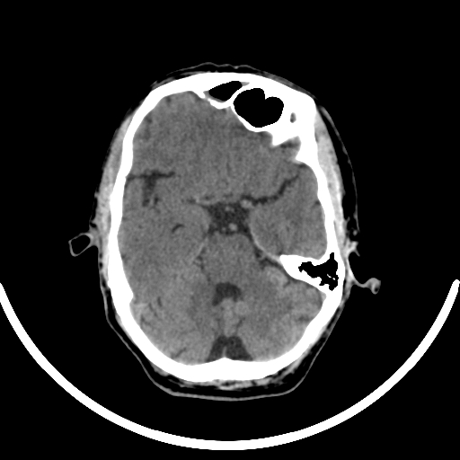 Chronic invasive fungal sinusitis with intraorbital and intracranial extension (Radiopaedia 56387-63046 Axial non-contrast 154).jpg