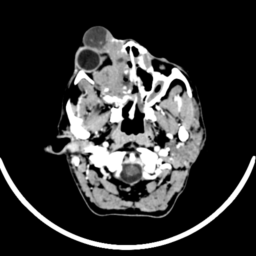Chronic invasive fungal sinusitis with intraorbital and intracranial extension (Radiopaedia 56387-63046 B 61).jpg