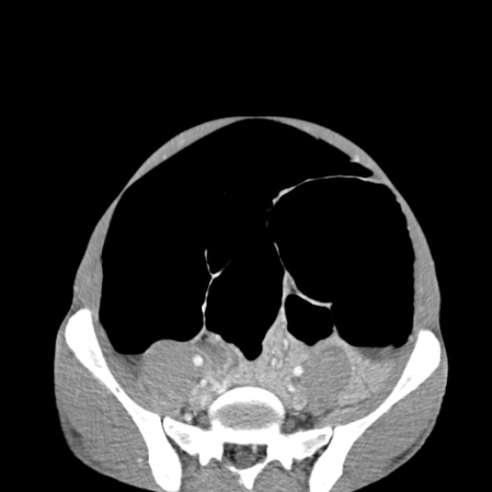 Chronic large bowel pseudo-obstruction (Radiopaedia 43181-46492 A 127).jpg