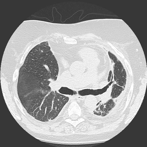 File:Chronic lung allograft dysfunction - restrictive form (Radiopaedia 60595-68316 Axial lung window 30).jpg