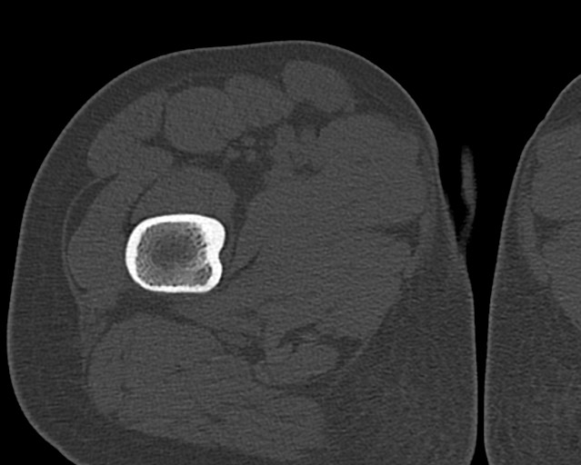 File:Chronic ostemyelitis of the femur with long sinus tract (Radiopaedia 74947-85982 Axial bone window 31).jpg