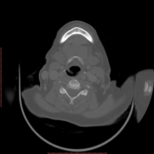 Chronic osteomyelitis - maxilla (Radiopaedia 23783-23927 Axial bone window 8).jpg