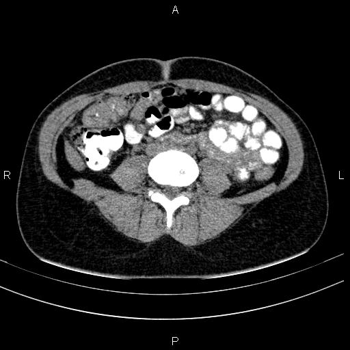 Chronic pancreatitis (Radiopaedia 64576-73450 Axial non-contrast 98).jpg