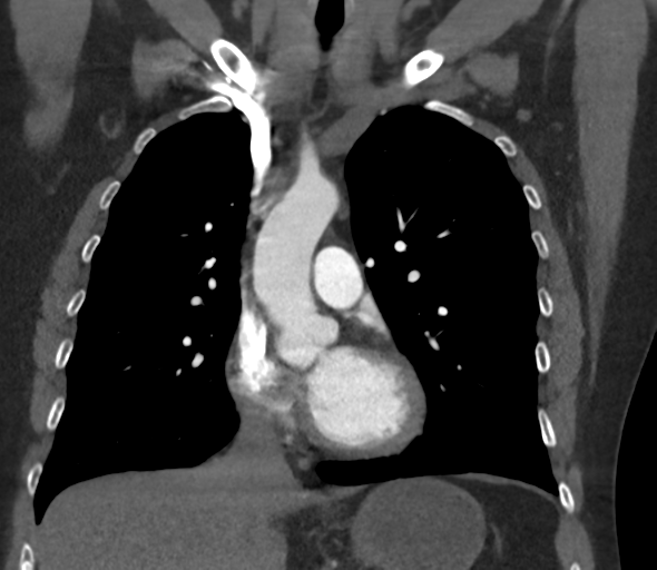 File:Chronic pulmonary embolus (Radiopaedia 39129-41341 Coronal C+ CTPA 38).png