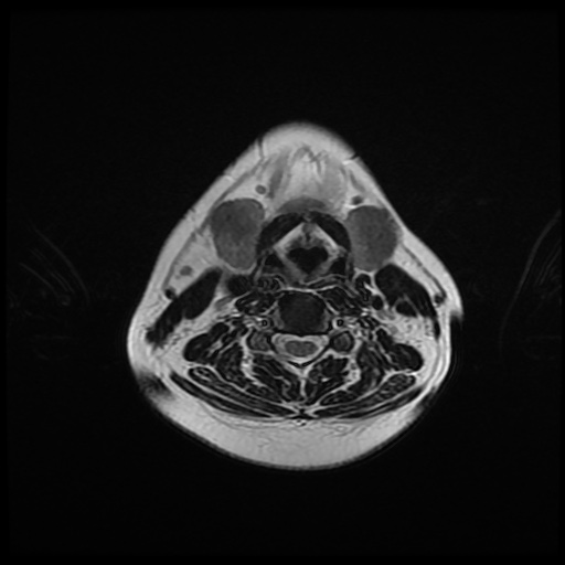 File:Chronic submandibular sialadenitis (Radiopaedia 61852-69885 Axial T2 18).jpg