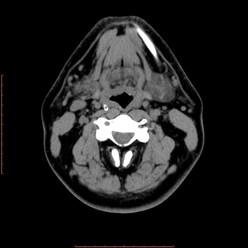 Chronic submandibular sialolithiasis (Radiopaedia 69817-79814 Axial non-contrast 119).jpg