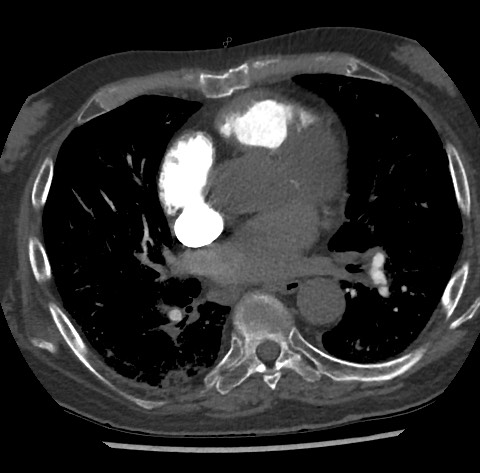 Chronic thromboembolic pulmonary disease (Radiopaedia 90694-108119 Axial C+ CTPA 56).jpg