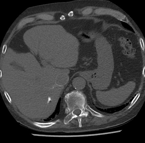 File:Chronic thromboembolic pulmonary disease (Radiopaedia 90694-108119 Axial C+ CTPA 88).jpg