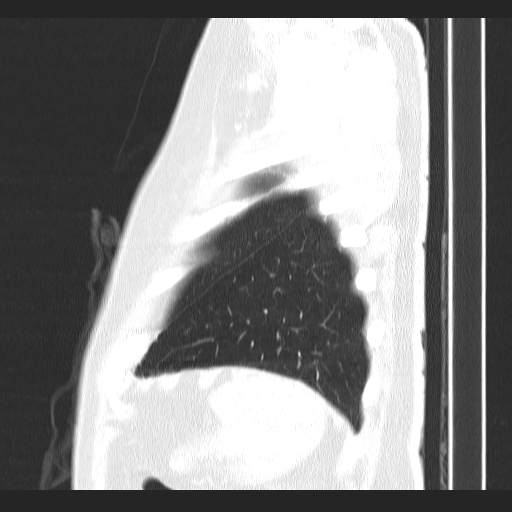 Classic complicated silicosis (Radiopaedia 49720-54961 Sagittal lung window 7).jpg