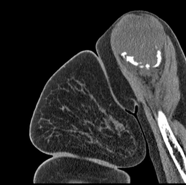 File:Clear cell chondrosarcoma - humerus (Radiopaedia 63104-71612 D 15).jpg