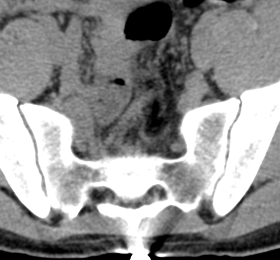 File:Clear cell meningoma - lumbar spine (Radiopaedia 60116-67691 Axial non-contrast 77).png