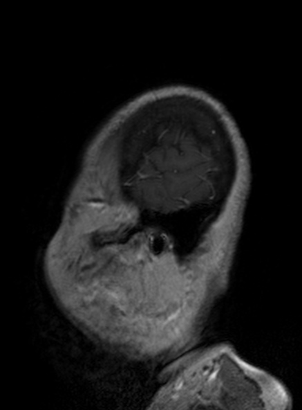 Clival meningioma (Radiopaedia 53278-59248 Sagittal T1 C+ 139).jpg