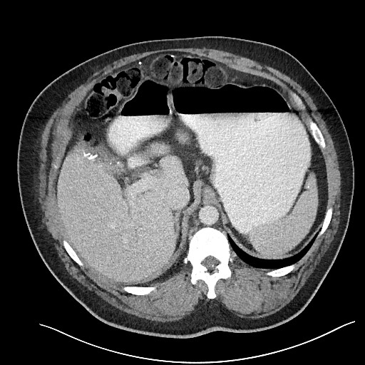 File:Closed loop obstruction - internal hernia into nephrectomy bed (Radiopaedia 59867-67320 A 35).jpg