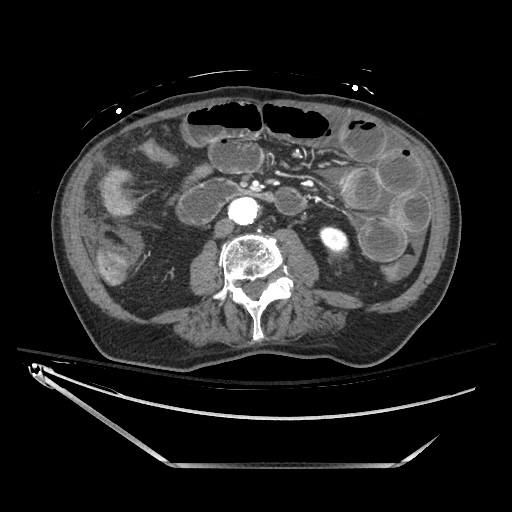 File:Closed loop obstruction due to adhesive band, resulting in small bowel ischemia and resection (Radiopaedia 83835-99023 B 79).jpg