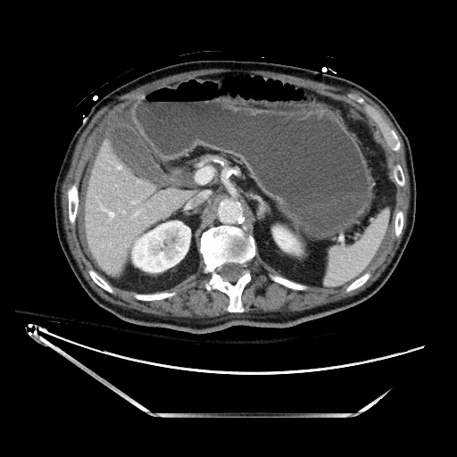 Closed loop obstruction due to adhesive band, resulting in small bowel ischemia and resection (Radiopaedia 83835-99023 D 48).jpg